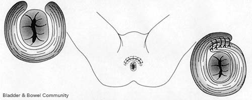 Sphincter Repair Surgery - Bladder & Bowel Community