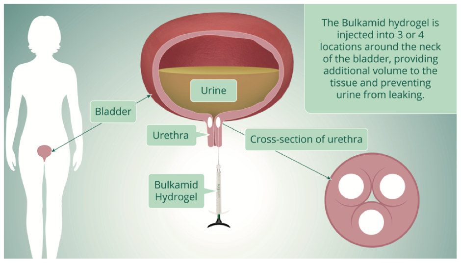 Urethral Bulking for Stress Urinary incontinence - Brazosport