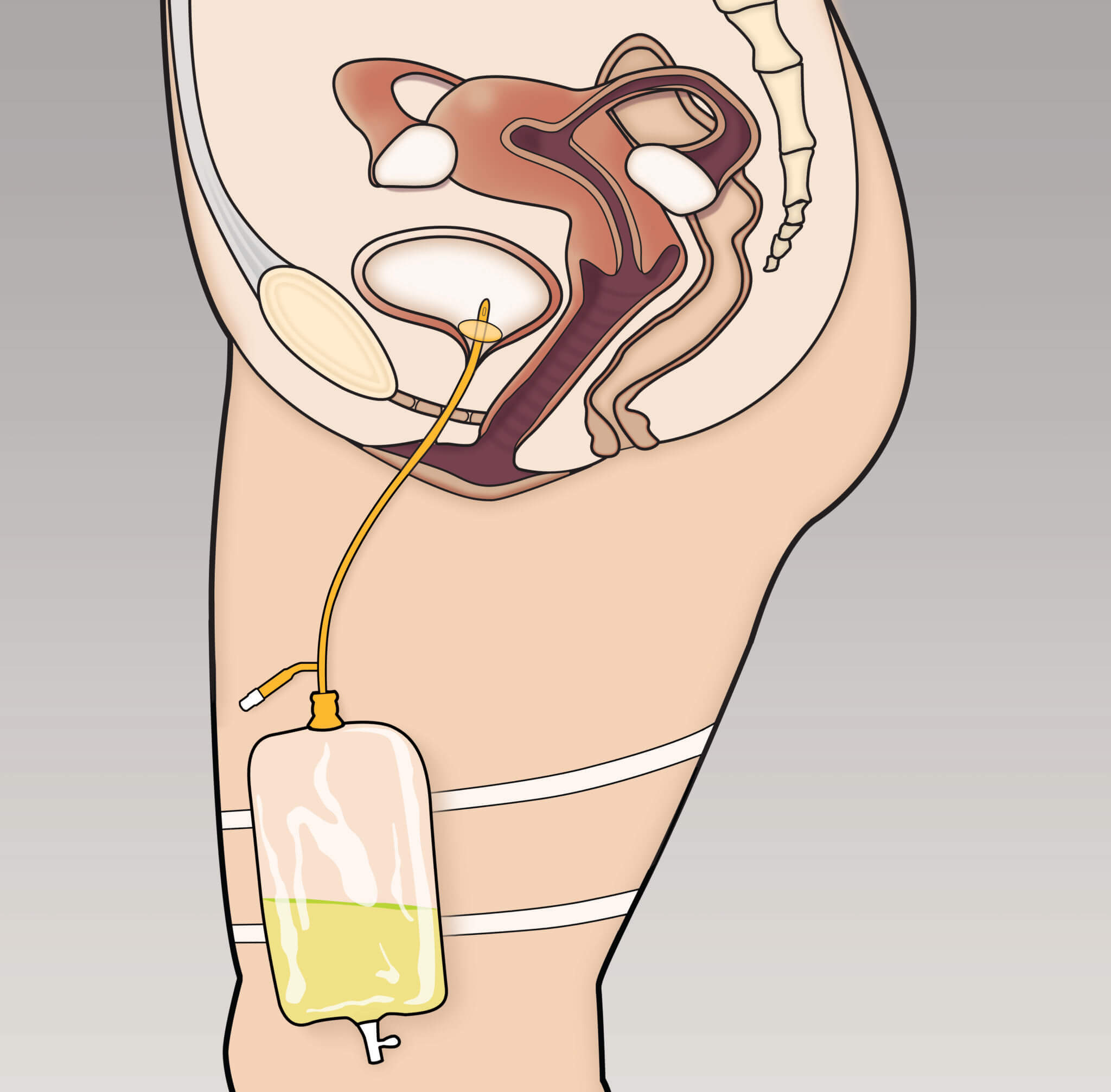 FEMALE_BAG_IN_SITU_P.07 Female catheter