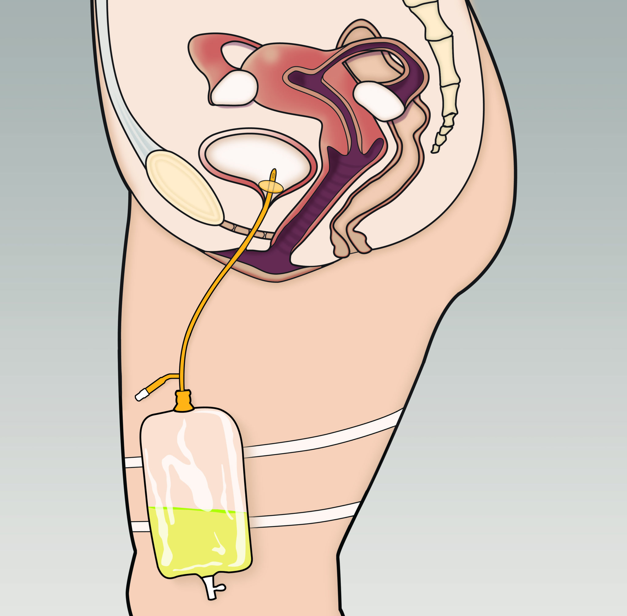 Female catheter