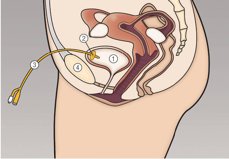 Female subrapubic catheter in situe