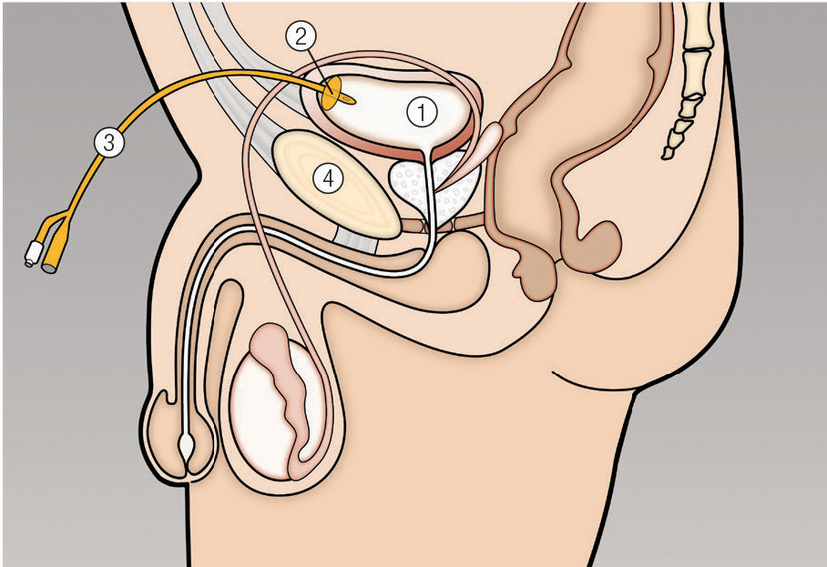 Male suprapubic catheter