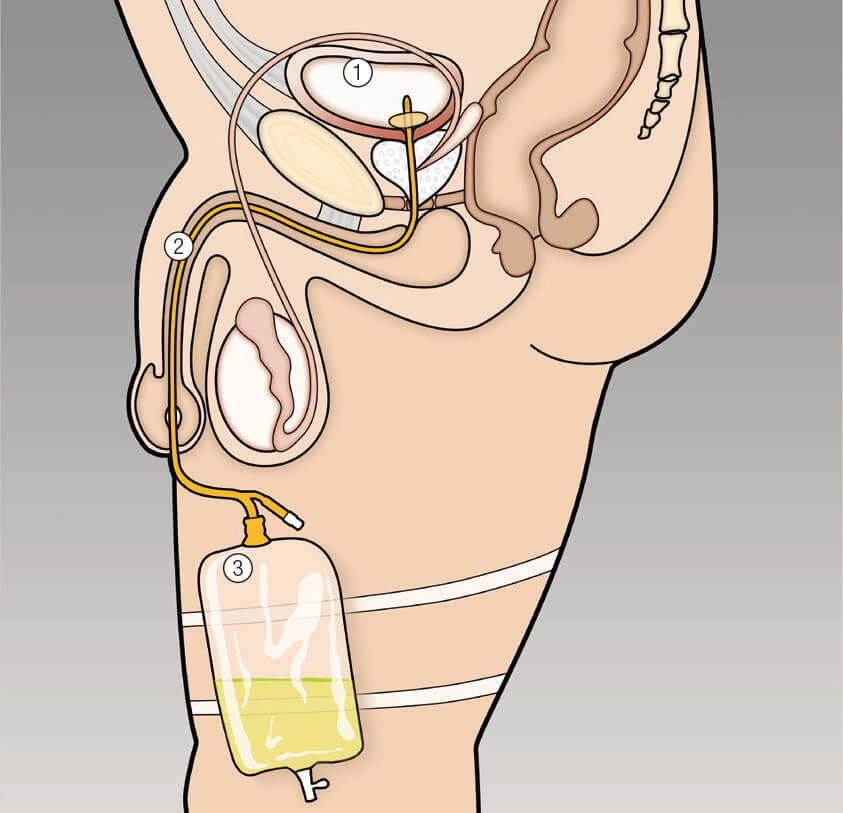 male-tract-cath-situ Male Catheter