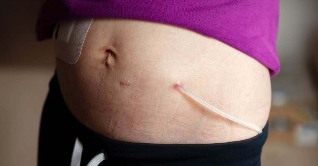 Peritoneal Catheter for Dialysis