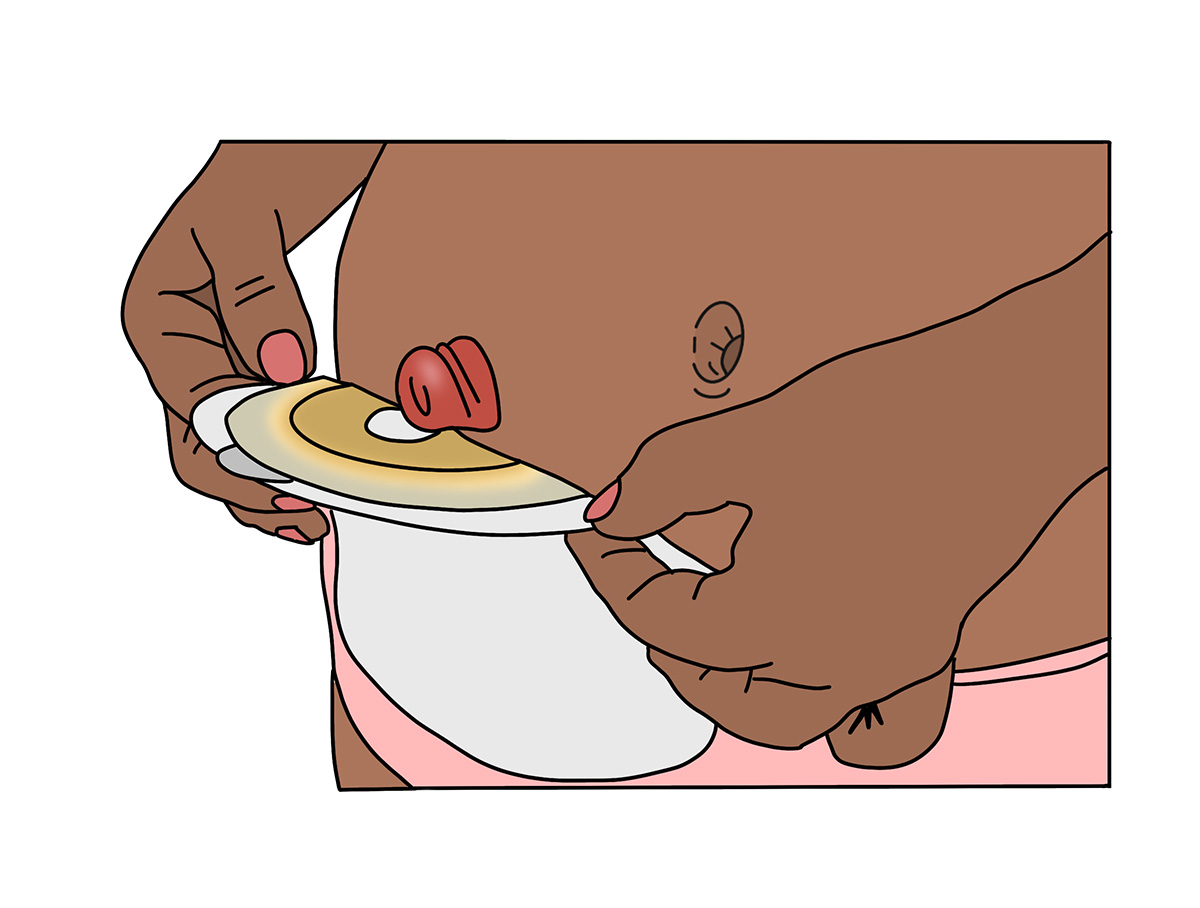 Stoma Bag Being Removed Illustration